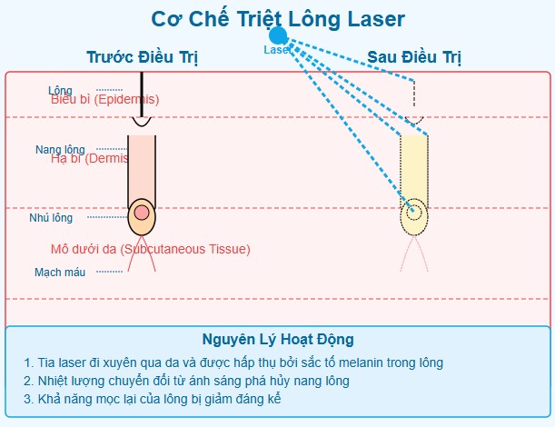 Phương pháp triệt lông hiệu quả & an toàn